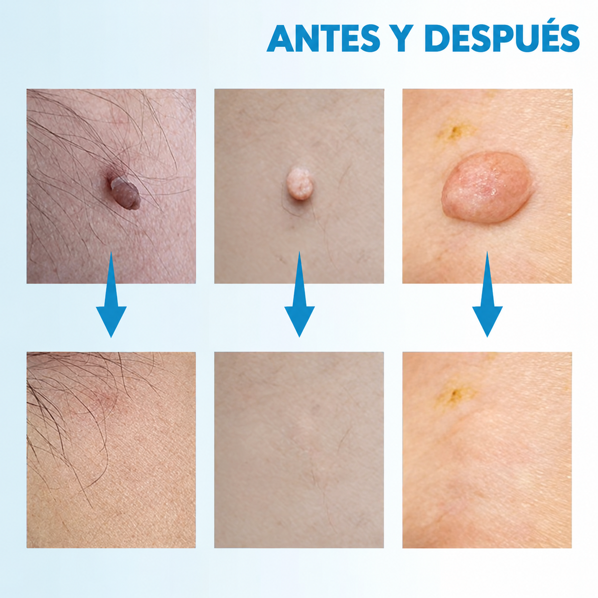 VERRUFIX | ELIMINA TUS VERRUGAS