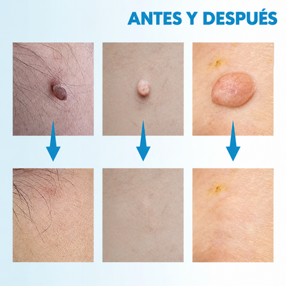VERRUFIX | ELIMINA TUS VERRUGAS